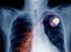 Описание и анализ этой атаки являются главной темой докладаPacemakers and - фото 22
