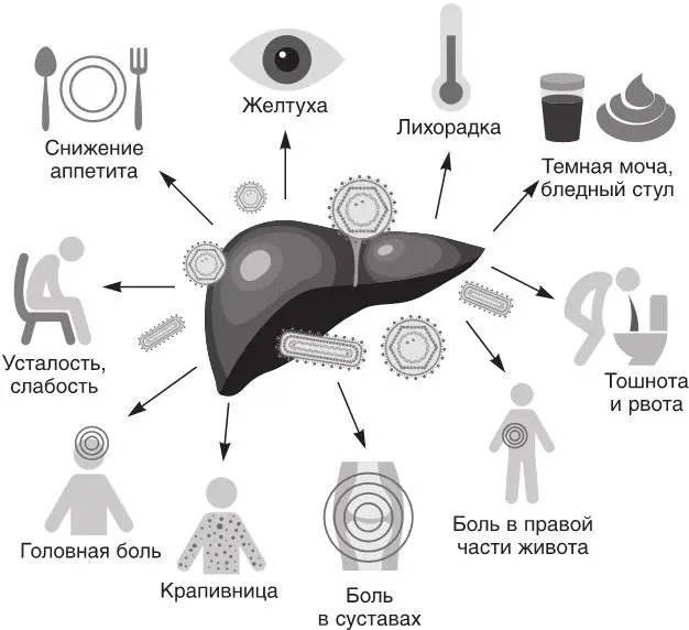 Рис 30 Проявления и симптомы гепатита В При фульминантном гепатите В сразу - фото 44