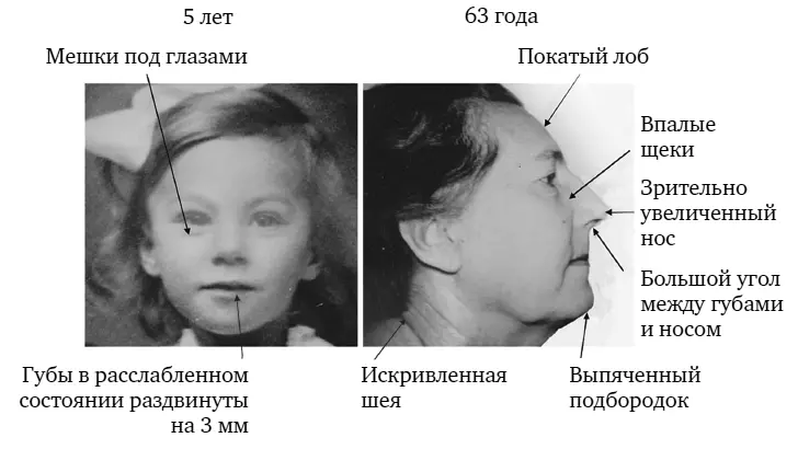 Рисунок 19В пять лет этот ребенок держал свой рот открытым Через 58 лет можно - фото 21