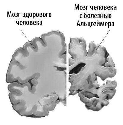 Самый явный симптом болезни Альцгеймера нарушения памяти На ранних стадиях - фото 10