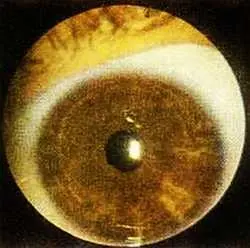 Рис 100 Симптом локальной депигментации в проекционной зоне легкого и - фото 59