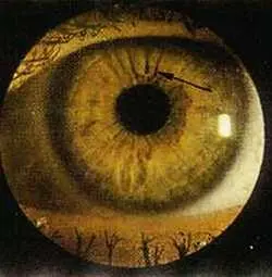 Рис 104 Солнечные лучи левый глаз Больной М 36 лет Диагноз - фото 60