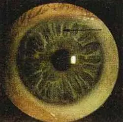 Рис 105 Белая лучистость правый глаз Больной Ю 57 лет Диагноз - фото 61