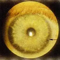 Рис 106 Дистрофический ободок правый глаз Больная С 44 года Диагноз - фото 62