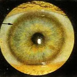 Рис 107 Дистрофический ободок наследственного происхождения правый глаз - фото 63