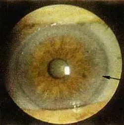 Рис 109 Натриевое кольцо левый глаз Больная Ч 65 лет Диагноз - фото 64