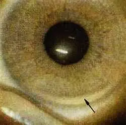 Рис 110 Натриевая дуга левый глаз Испытуемый В 13 лет Диагноз - фото 65