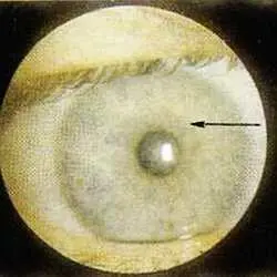 Рис 112 Матовый пояс окружающий автономное кольцо правый глаз Больной - фото 66