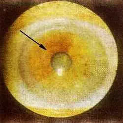 Рис 114 Созревший токсический сектор левый глаз Больная С 63 года - фото 68