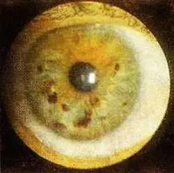 Рис 115 Пигментные пятна радужки правый глаз Больной X 49 лет Диагноз - фото 69