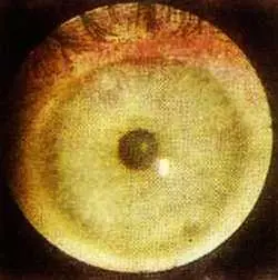 Рис 118 Мелоподобная радужка левый глаз Больная Д 40 лет Диагноз - фото 70