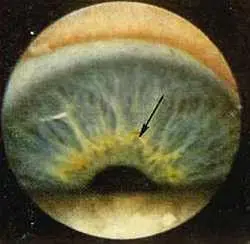 Рис 123 Выбухающее автономное кольцо и пигментное пятно в проекционной зоне - фото 72