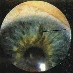 Рис 124 Разорванность автономного кольца и гигантская лакуна в мозговом - фото 73