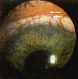 Рис 125 Выраженная сеть инъецированных сосудов конъюнктивы левый глаз - фото 74
