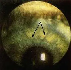 Рис 126 Щелевидные лакуны по краям мозговой зоны радужки левый глаз - фото 75