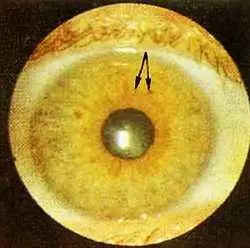 Рис 127 Пигментное пятно и две микролакуны в проекционной зоне - фото 76