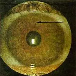 Рис 128 Ланцетовидная лакуна в проекционной зоне левой теменной доли мозга - фото 77