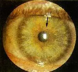 Рис 129 Втянутое автономное кольцо и шлаковые полосы в проекционной зоне - фото 78