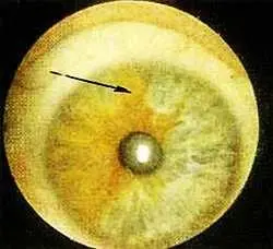 Рис 130 Лакуна и пигментный сектор в проекционной зоне теменной доли левый - фото 79