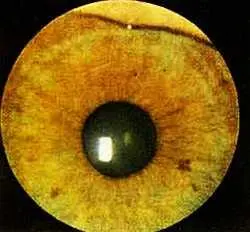 Рис 132 Тотальная пигментная за вуалированность зрачкового пояса левый - фото 80