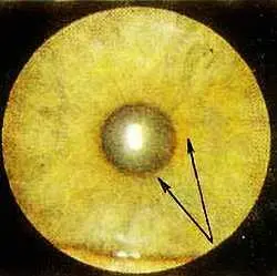 Рис 136 Ореолоподобная зрачковая кайма пигментный сектор и симптом - фото 83