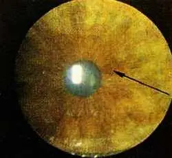 Рис 137 Деформация зрачка тонкая зрачковая кайма и крупное пигментное пятно - фото 84