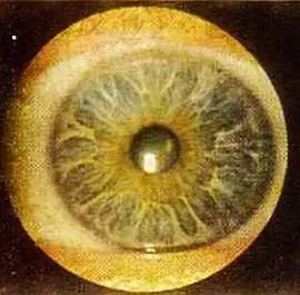 Рис 49 Радиальнолакунарный тип радужки левый глаз Больной Ю 57 лет - фото 46