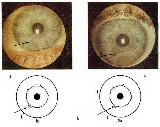 Рис 52 Наследование иридодиагностических признаков АВыбухание автономного - фото 47