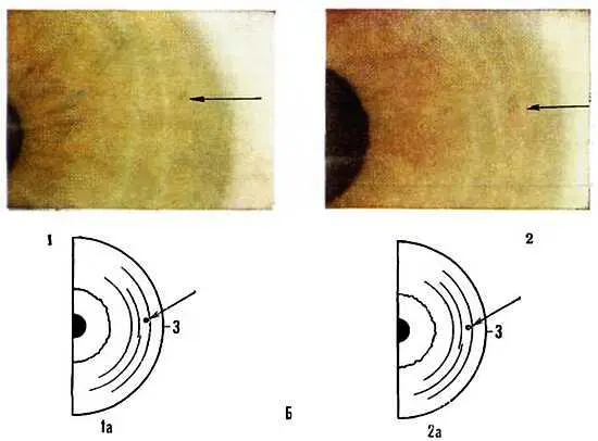 Рис 52 Наследование иридодиагностических признаков АВыбухание автономного - фото 48