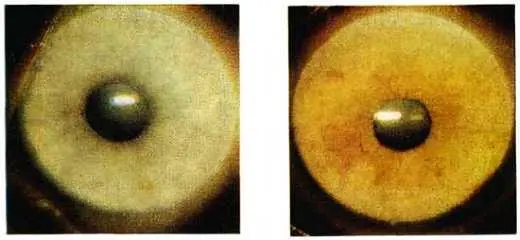 Рис 55 Гетерохромия различная окраска радужки глаз Больной 3 48 лет - фото 50