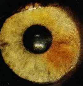 Рис 57 Пигментный сектор возникший с 13летнего возраста правая радужка - фото 52