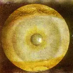 Рис 91 Равномерно утолщенная форма зрачковой каймы правый глаз Испытуемая - фото 55