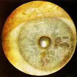 Рис 92 Изъеденная молью зрачковая кайма левый глаз Больная П 57 лет - фото 56