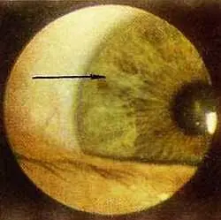 Рис 95 Симптом локона в проекционной зоне правого легкого правый глаз - фото 57