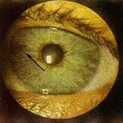 Рис 99 Симптом расщепления волокон в проекционной зоне щитовидной железы и - фото 58