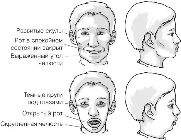 Рис 10 Развитие лица и дыхание ртом у детей Следует понимать что все эти - фото 15