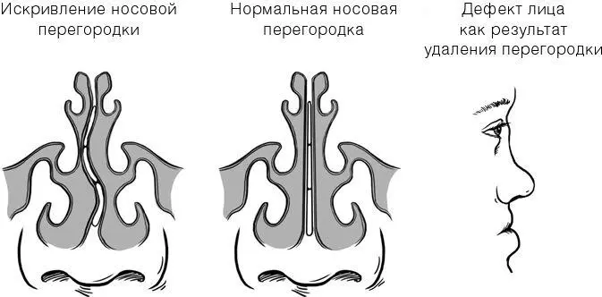 Рис 13 Искривленная носовая перегородка форма и развитие лица Витамин A - фото 19