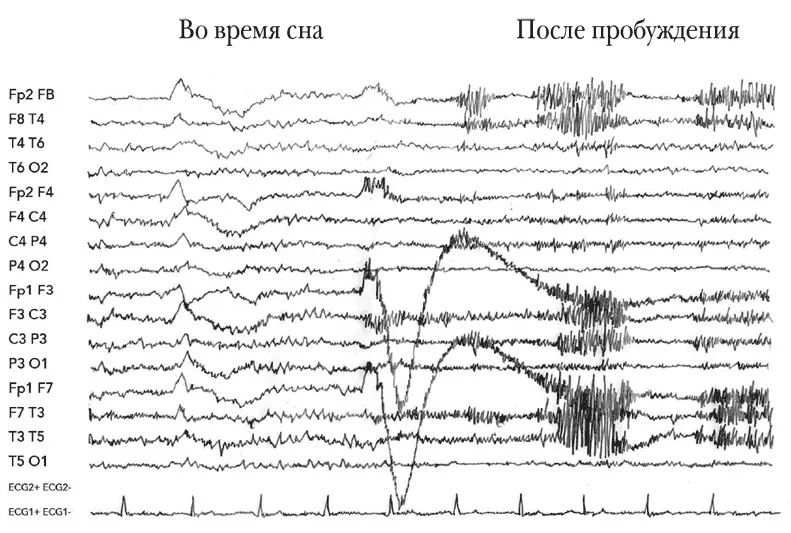 ЭЭГ во время сна и после пробуждения Результаты МРТ в норме но ЭЭГ - фото 3