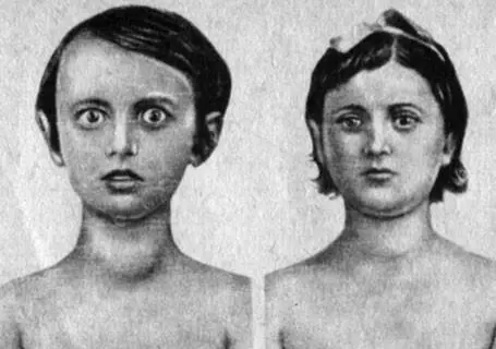 Рис 45 Слева больная с резко выраженной формой базедовой болезни справа та - фото 111