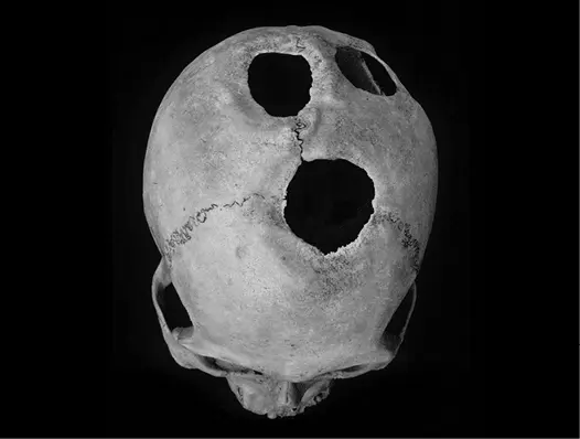Ископаемый череп с прижизненными трепанационными отверстиями Кстати говоря в - фото 5