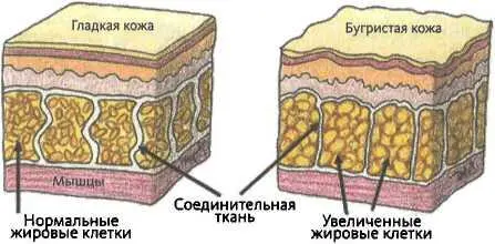 Рис 1191 Целлюлит топографические изменения рельефа кожи выражающиеся в - фото 92