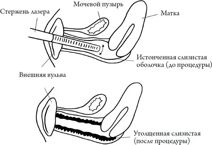 Гормонозаместительная терапия и комплексный подход Среди медиков ведутся - фото 255