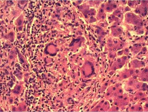 Рисунок 25 Больная Я 34 года Диагноз коинфекция ВИЧ и HCV туберкулезная - фото 31