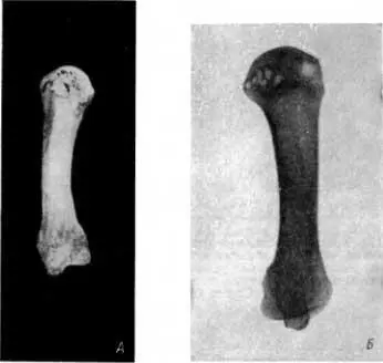 Рис 125 А III пястная кость со множественными кистовидными изменениями в - фото 127