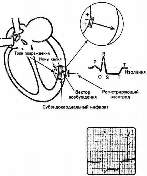 Рис 101 Схематическое изображение субэндокардиального инфаркта миокарда Ионы - фото 101