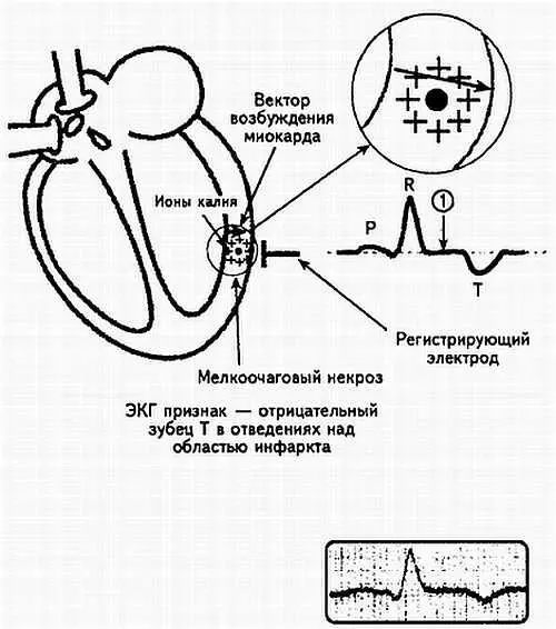 Рис 102 Схематическое изображение интрамурального инфаркта миокарда При этой - фото 102