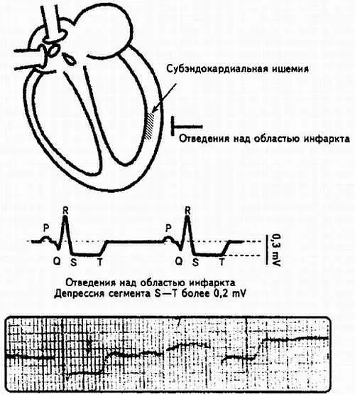 Рис 103 Схематическое изображение острейшей стадии инфаркта миокарда - фото 104