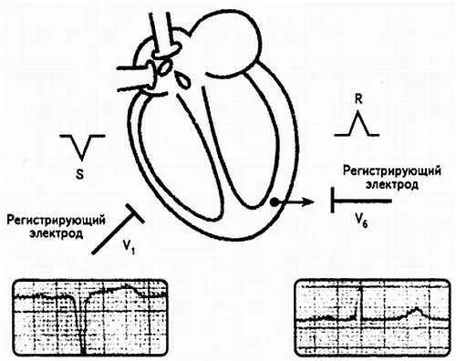 Рис 27 Регистрация результирующего вектора электродами отведений V 1и V 6 - фото 27