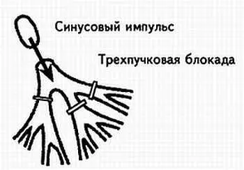 Рис 57 Схематическое изображение блокады всех трех пучков проводящей системы - фото 57