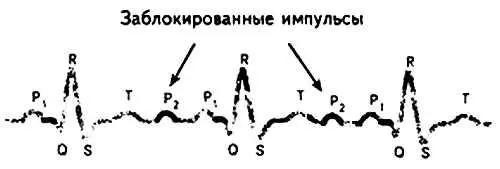 Рис 61 Неполная атриовентрикулярная блокада 2й степени Мобитц 2 с - фото 61
